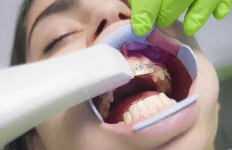 Estrazione dente Roma