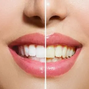 Sbiancamento denti