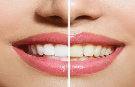 Servizio sbiancamento denti Roma